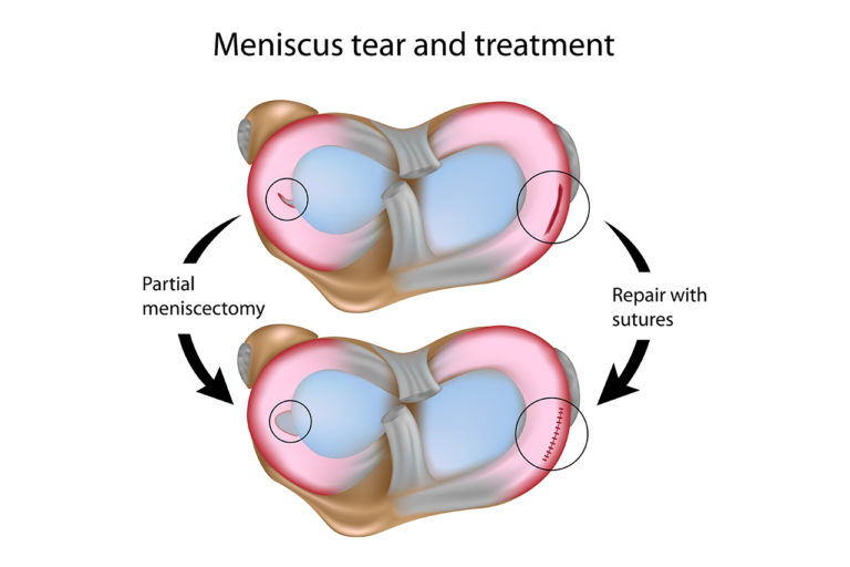 Meniscus Tear